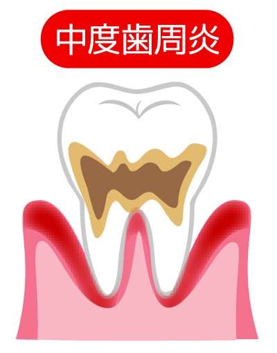 中等度歯周炎