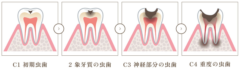 むし歯の進行と根管治療の関係